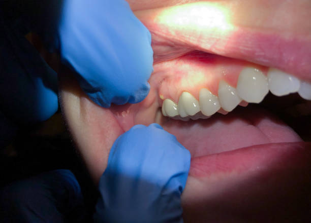 Best Emergency Dentist for Lost Fillings or Crowns in Carrollton, IL