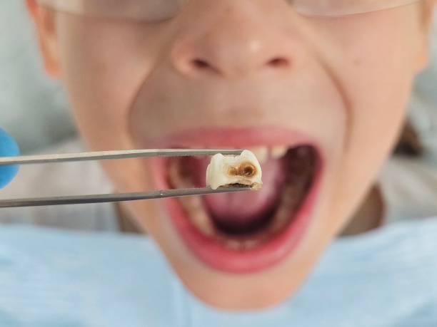 Best Emergency Root Canal Treatment in Carrollton, IL